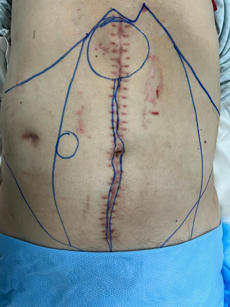 A view from umbilical hernia accompanied by diastasis recti and